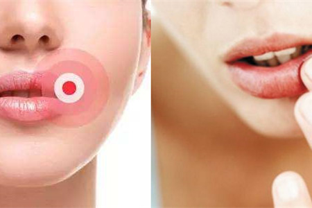 九游娱乐：【图】嘴角长疱疹图片教你如何巧妙应对(图2)